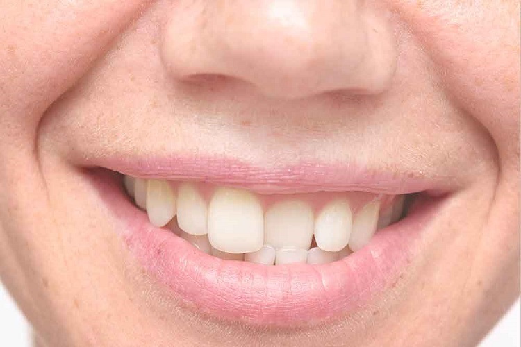 Why Get Invisible Braces for Misaligned Teeth?