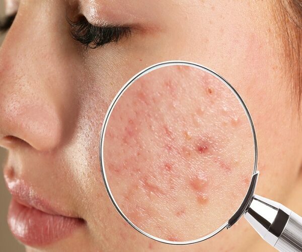 Living With Acne