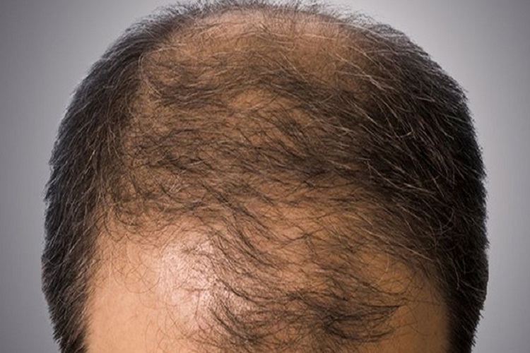 The Relationship Between Stress & Hair Loss
